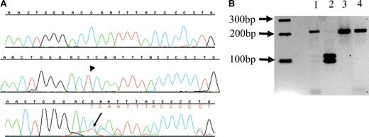 Figure 4. 6884_6885 insT ATRX mutation in a patient with ATMDS. (A) Sequences from patient no. 12, exon 33 (5′ to 3′, running left to right). The top line is a sequence from a normal subclone, the middle line represents one of the 10% of subclones bearing the thymidine insertion 6884_6885insT (arrowhead) that results in a frame shift, and the lower line is unfractionated marrow DNA, where the inserted thymidine (red, with arrow) can be seen as a secondary peak under the 3′ cytidine (blue); this is followed by a series of secondary peaks (denoted in red letters under primary base calls) as a result of the frame shift. (B) Hinf I digest from patient no. 12. The predicted normal exon 33 amplicon digestion fragments are 218-bp and 21-bp long. The T insertion at 6884_6885insT expands the amplicon from 239 bp to 240 bp and creates a new restriction site, leading to 3 digestion fragments of lengths 115 bp, 104 bp, and 21 bp. A 2-log DNA ladder (New England Biolabs) is at far left. Lane 2 is a digest of a subclone containing 6884_6885insT, and has the predicted 115-bp and 104-bp fragments. Lane 3 is a digest of a subclone from patient no. 12 where sequencing did not show the mutation, and only the 218-bp fragment can be seen, similar to lane 4, a wild-type control with only the 218-bp fragment. Lane 1 is a digest of amplified unfractionated marrow DNA from patient no. 12, and contains both the normal 218-bp fragment as well as faint bands corresponding to the 115-bp and 104-bp fragments from the minor population of mutant DNA.