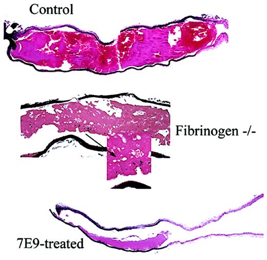 Figure 6. Compared to control, fbg–/– mice produce loosely packed thrombi with large pores and 7E9-treated mice produce small mural thrombi. Sections stained with hematoxylin and eosin from carotid artery segments obtained 30 minutes after FeCl3-induced injury. Carotid sections from a control mouse (original magnification × 4), a fbg–/– mouse (original magnifications × 10 and × 60), and a 7E9-treated mouse (original magnification × 4). Arrow shows unusually large pores observed only in thrombi of fbg–/– animals.