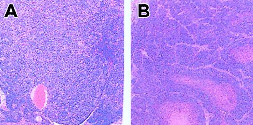 Figure 1. Hematoxylin and eosin–stained, paraffin-embedded tissue sections from old C57Bl/6 Fancc-/- mice. (A) Small intestine lymph node showing histiocytic sarcoma with sheets of neoplastic cells characterized by eosinophilic cytoplasm and pleomorphic nuclear morphology. (B) Mammary adenocarcinoma with well-circumscribed and encapsulated mass composed of neoplastic cells with oval or polyhedral nucleus with either amphophilic nuclei and stippling or coarse pattern to their chromatin. Anisokaryosis is 2-fold and mitotic index is 5. Original magnification × 100.