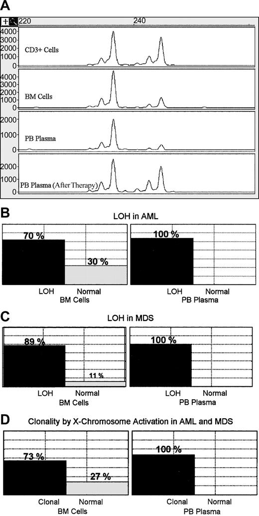 Figure 1. Detection of LOH and X-chromosome inactivation in bone marrow cells and peripheral blood plasma. (A) Representative example showing LOH in bone marrow cells and PB plasma before therapy and disappearance of the LOH when the patient was in remission. (B) Box plots showing positive and negative cases for LOH as detected in 37 BM cell samples from patients with AML. All tested corresponding PB plasma samples (27 samples) showed LOH. (C) Positive and negative cases for LOH detected in 27 samples of BM cells from patients with MDS, while all tested corresponding PB plasma samples (25 samples) showed LOH. (D) Monoclonality and polyclonality were detected by X-chromosome inactivation in BM cell samples from 26 patients with AML or MDS, whereas all tested plasma samples (22 samples) were monoclonal.