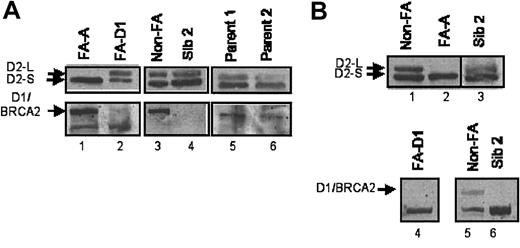 Figure 1. Absence of BRCA2 protein in FA-D1 cells. (A). Kindred 1-sibling 2 does not express BRCA2. Lymphoblast cell lines established from an FA subtype A patient (lane 1), an FA subtype D1 patient (lane 2), a control non-FA patient (lane 3), or member of kindred 1 (lanes 4-6) were lysed and immunoblotted with an antibody against FANCD2 (top panels) or BRCA2 (bottom panels). Cell lysates from sibling 2 contained ubiquitinated FANCD2 but were missing the BRCA2 protein. (B). Kindred 2-sibling 2 does not express the BRCA2 protein. Lymphoblast cell lines established from a control non-FA patient (lanes 1 and 6), an FA subtype A patient (lane 2), an FA subtype D1 patient (lane 5), or kindred 2-sibling 2 (lanes 3, 4, and 7) were lysed and immunoblotted for FANCD2 (top panels, lanes 1-4) or BRCA2 (bottom panels, lanes 5-7). Lanes 3 and 4 represent 2 different lysates from sibling 2. Ubiquitinated FANCD2 was detectable in lysates from sibling 2, but FANCD1/BRCA2 was absent.