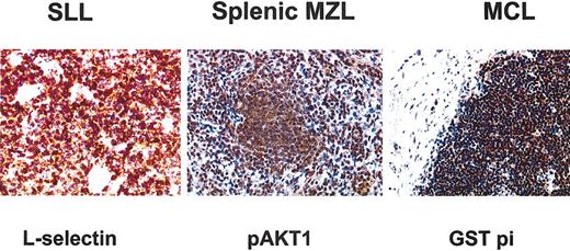 Figure 4. Immunohistochemical staining for the 3 antibodies chosen for their specificity from the microarray data. GST pi immunostaining showed a strong signal in all cyclin D1-positive MCL samples. L-selectin protein expression was specifically expressed in SLL samples. pAKT1 immunostaining showed a strong signal in MZL samples. Original magnification, × 250.