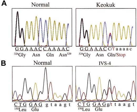 Figure 5. DNA sequence analysis. (A) DNA sequencing of exon 5 of the fibrinogen Aα gene showed that II.1 and II.2, their brother (II.3), and his son (III.1) had a heterozygous C>T mutation that changed the CAA codon for residue Gln328 to a TAA stop codon and was the cause for the Keokuk truncation of the Aα constituent chain of the protein. (B) II.1 and II.2 and their mother (I.2) had a heterozygous mutation (IVS4 + 1 G>T) in intron 4 at the invariant 5′ splice site of this gene. Representative examples of each mutation are shown.