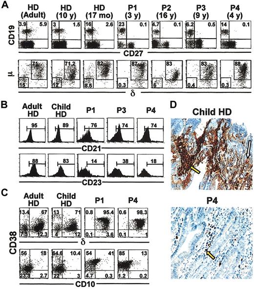 Figure 1. Absence of circulating memory B cells and gut plasma cells and accumulation of newly generated B cells in PB of ICF patients. PBMCs from 4 ICF patients (P1 to P4) and HDs were analyzed by flow cytometry (panels A-C). In panels A to C, representative dot plots and histograms are shown for 1 adult and 1 child HD of 5 adults and 5 children. (A) Four-color flow cytometry analysis of anti-CD19, anti-CD27, anti-δ, and anti-μ staining. Expression of CD19 and CD27 on PBLs and of surface μ and δ within the CD19+ gate are represented in the top and bottom subpanels, respectively. (B) PBMCs from P1, P3, P4, and HDs were stained with anti-CD19, anti-CD27, and anti-CD21 or anti-CD23 and analyzed within the CD19+CD27- gate. (C) PBMCs from P1, P4, and HDs were stained with anti-CD19, anti-CD38, anti-δ, and anti-CD10 and were then analyzed within the CD19+ gate. Numbers in quadrants (A,C) and brackets (B) indicate percentage of cells within the corresponding gate. (D) Jejunal sections from a healthy child and P4 were paraffin embedded and formalin fixed. IgA staining is shown in red, hematoxylin counterstaining in blue; magnification, × 250. IgA+ plasma cells (PCs) are indicated by yellow arrows; secretory IgA is indicated by a white arrow. Results are representative of P2, P3, P4, and 10 age-matched controls.