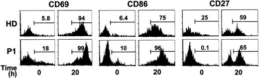Figure 2. Response of ICF B cells to BCR stimulation and CD40 cross-linking. Flow cytometry analysis of PBMCs from a healthy child (HD) and patient P1 stained with anti-CD19, anti-CD69, anti-CD86, and anti-CD27, gated on CD19+ cells at time zero or after 20 hours' stimulation. Numbers in brackets indicate the percentage of strained cells within the CD19+ cells. Cells were stimulated by coculture with irradiated hCD40L-transfected fibroblasts in the presence of F(ab) antihuman μ, rIL-2, and rIL-10. P1 data are representative of P1, P3, and P4; HD data are representative of 3 healthy children.