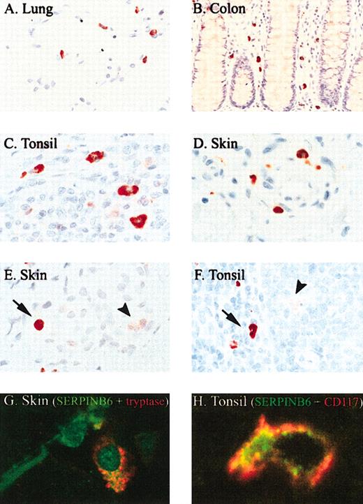 Figure 2. SERPINB6 is expressed by mast cells in different tissues. Tissue sections were stained for SERPINB6 expression (mAb PI6-18; A-F) and mast cell tryptase (mAb AA1; G-H), as described in “Patients, materials, and methods.” Slides were stained with AEC and counterstained with hematoxylin. Arrow indicates mast cell showing strong SERPINB6 staining (E-F); arrowhead, neutrophil (E) or starry sky macrophage (F) with weak SERPINB6 staining. Original magnifications, × 400 (B), × 630 (A, F), and × 1000 (C-E). (G) Fluorescent double staining of SERPINB6 (green) with tryptase (red) in skin. (H) Fluorescent double staining of SERPINB6 (green) with CD117 (red) in tonsil. In the latter a clear membranous staining of CD117 is seen. Original magnifications, × 1000 (G-H).