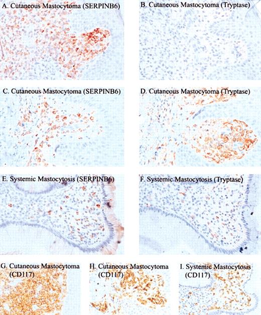 Figure 4. Immunohistochemical detection of SERPINB6, tryptase, and CD117 in mastocytosis. Tissue sections of 2 cutaneous mastocytomas in patient 12 (A-B, G) and patient 10 (C-D, H) and of systemic mastocytosis in patient 14 (E-F, I) were stained with mAb PI6-18 (A, C, E), antitryptase mAb AA1 (B, D, F), or anti-CD117 (G-I). Slides were stained with AEC (A-F) or DAB (G-I) and were counterstained with hematoxylin. Original magnification, × 400 (A-I).