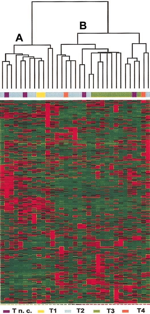 Figure 1. Hierarchical clustering of the 33 T-ALL samples based on expression of 313 selected genes. Each column represents a sample and each row represent a gene. Relative levels of gene expression are depicted with a color scale where red represents the highest level of expression and green represents the lowest level. Unsupervised clustering identified 2 subsets of samples, A and B.