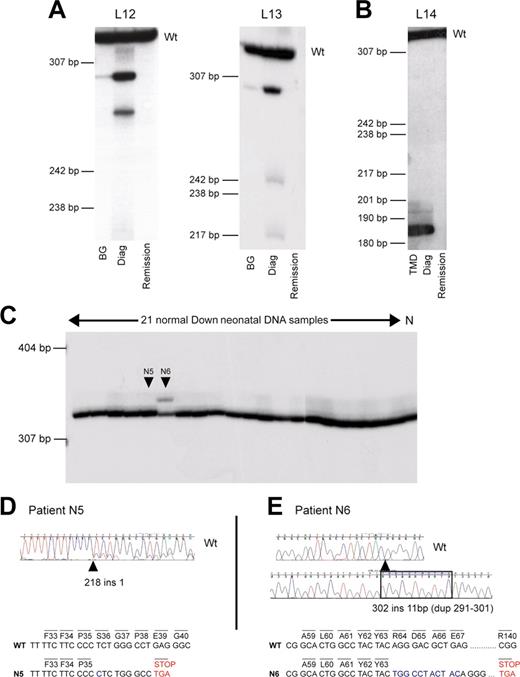 Figure 2. GATA1 mutations can be clinically silent at birth. Analysis of GATA1 mutations in sequential genomic DNA samples in AMKL patients and healthy DS neonates. (A-B) Sequential genomic DNA samples from patients L12 and L13 (A), and L14 (B) were used as a template to amplify radiolabeled GATA1 exon 2. PCR products were then separated on a polyacrylamide gel. Wt indicates the position of the wild-type GATA1 exon 2 PCR product. DNA samples used were neonatal blood spot DNA (BG); diagnostic AMKL DNA (Diag); and remission DNA sample. Patient L14 presented with TMD at birth, and this sample was used in the analysis. Positions of DNA size markers (in base pairs) are indicated on the left. (C) Genomic DNA from 21 unselected healthy DS neonates and one non-DS control (N) was used as template to amplify radiolabeled GATA1 exon 2. PCR products were then separated on polyacrylamide gel; 2 of 21 (N5 and N6) samples tested had detectable mutations (D-E). (D) Neonate N5 has a mutation in GATA1 exon 2, 218 ins 1, detected by direct sequencing of GATA1 exon 2 PCR product amplified from genomic DNA. Note that there are 2 sequences in the chromatogram indicative of 2 GATA1 PCR products, wild type and mutant. The minor trace sequence corresponds to the mutant product, reflecting its lower abundance relative to wild type. (E) Neonate N6 has a mutation in GATA1 exon 2, 302 ins 11 (dup291-301). The mutant-sized GATA1 exon 2 product (C) was excised from the gel and cloned, and sequence of the cloned product is shown. Wild-type GATA1 exon 2 sequence is illustrated for comparison. The predicted consequences of mutations in both N5 and N6 are shown. In N5, mutation leads to a stop codon before codon 84. In N6, mutation is predicted to terminate at codon 140.