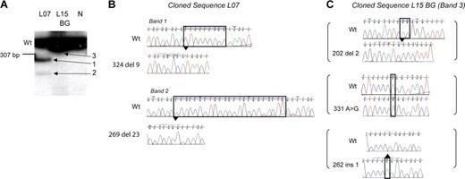 Figure 3. Multiple independent GATA1 mutations are present. (A) Radiolabeled GATA1 exon 2 PCR products generated from genomic template of patient L07 and L15's neonatal blood spot (BG) and a healthy control (N) were separated on a polyacrylamide gel. The wild-type GATA1 product is marked (Wt). Patient L07 has a single wild-type-sized band and 2 extra bands (bands 1 and 2). L15 has only one wild-type-sized product (panel C, band 3). (B-C) Radiolabeled GATA1 exon 2 bands from patient L07 and L15's BG shown in panel A were excised, cloned, and sequenced. Sequence chromatograms of clones from patient L07 (B) and L15 (C) are shown. Mutant traces are illustrated, and wild-type (Wt) traces are depicted for comparison.