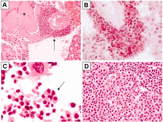 Figure 4. Bcl-XL mice develop plasma cell pathology. (A) H&E-stained section of a kidney from a Bcl-XL mouse with a hyaline tubular cast (asterisk) and a perivascular focus of plasma cells (arrow). (B) CD138-immunostained (red reaction product) kidney section from a 3′KE/Bcl-XL mouse, counterstained with hematoxylin. (C) H&E-stained section of a femur of a 3′KE/Bcl-XL mouse demonstrating a bone marrow plasma cell focus (arrow). (D) H&E-stained section of a lymph node of a 3′KE/Bcl-XL mouse with plasma cell aggregates. Original magnifications: × 40 (A,D) and × 100 (B-C).