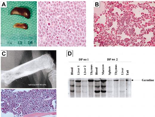 Figure 6. Mice coexpressing Bcl-XL and c-Myc develop clonal B- and plasma cell tumors. (A) (Left) Spleens from a double transgenic (top) and littermate control (bottom) mousee. (Right) H&E-stained spleen section of a double transgenic mouse. Cells are pleomorphic with an elevated mitotic index. (B) H&E-stained section of a lung of a double transgenic mouse. Aggregates of lymphocytes line the alveolar walls. (C) Radiography (top) demonstrates areas of bone lysis, and the H&E-stained section of the femur of a double transgenic mouse (bottom) shows replacement of bone marrow by sheets of plasma cells. (D) Southern analysis of samples collected from double transgenic mice (DP indicates double positive). Original magnifications: × 10 (C, top panel); × 40 (B; C, bottom panel); and × 100 (A, right panel).