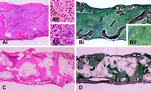 Figure 1. Bone marrow biopsy from a patient with AML and myelofibrosis arising from chronic eosinophilic leukemia. Bone marrow biopsies are shown before (A-B) and after (C-D) imatinib treatment. (A) Marrow biopsy section (Ai; hematoxylin and eosin; original magnification, × 4) is hypercellular with scattered eosinophils (Aii; original magnification, × 20) and columnar arrays of immature myeloid cells (Aiii; original magnification, × 20). (B) Reticulin stain highlights severe fibrosis (magnified view, Bii; original magnification, × 10). After 3 months of imatinib therapy, (C) marrow biopsy reveals marked hypocellularity without increased immature myeloid cells or eosinophils, and (D) reticulin stain shows markedly diminished fibrosis (original magnification, × 4 for panels C and D). After an additional 3 months, the patient relapsed with bone marrow findings similar to those in panels A and B. Screening of the FIP1L1-PDGFRA fusion at the time of relapse revealed the interval development of an imatinib resistance mutation (T674I) within the PDGFRA gene.