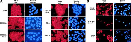 Figure 1. Immunocytochemical localization of NF-κB. Localization in human multiple myeloma cell lines (A), peripheral blood mononuclear cells (PBMCs) and CD138+ cells from healthy volunteers, and bone marrow CD138+ multiple myeloma cells from patient no. 1 (B). PBMCs were collected from the blood of a healthy subject by Ficoll-Paque density gradient centrifugation. CD138+ cells were enriched from bone marrow aspirates of a healthy volunteer and a multiple myeloma patient (patient no. 1), enriched by magnetic bead separation method, and immunostained for NF-κB (p65) as described in “Patients, materials, and methods.” Red stain indicates specific staining for NF-κB as indicated, whereas blue stain indicates the relative position of the nuclei in the corresponding view.