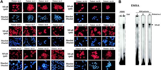 Figure 2. Nuclear localization of NF-κB in bone marrow CD138+ multiple myeloma cells from patients. (A) Enriched CD138+ cells from bone marrow aspirates of different multiple myeloma patients were immunostained for NF-κB (p65) as described in “Patients, materials, and methods.” Red stain indicates the specific staining for NF-κB, whereas blue stain indicates a relative position of the nuclei in the corresponding view. Original magnification, × 200 (B) Enriched CD138+ cells (2 × 106 cells) from bone marrow aspirates of multiple myeloma patients were tested for NF-κB activity in the nuclei by electrophoretic mobility shift assay as described in “Patients, materials, and methods.” Untreated or TNF-treated KBM-5 cells (TNF, 1 nM, 30 minutes) were used as negative and positive controls, respectively.