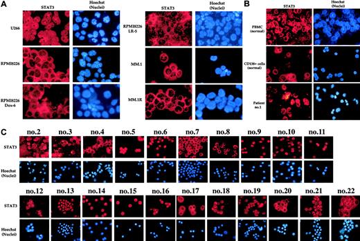 Figure 3. Nuclear localization of STAT3. Localization in MM cell lines (A) and PBMCs and bone marrow CD138+ cells from healthy volunteers and from multiple myeloma patients (B-C). Enriched CD138+ cells from bone marrow aspirates of healthy volunteers and multiple myeloma patients were immunostained for STAT3 as described in “Patients, materials, and methods.” Red stain indicates the specific staining for STAT3, whereas blue stain indicates the relative position of the nuclei in the corresponding view. Patient's numbers are indicated above each panel in C. Original magnification, × 200.