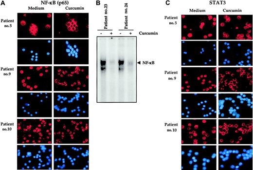 Figure 4. Curcumin prevents nuclear localization of NF-κB and STAT3 in bone marrow CD138+ multiple myeloma cells. Enriched CD138+ cells (1 × 105/0.1 mL) from bone marrow aspirates of multiple myeloma patients were cultured in the absence or presence of curcumin (50 μM) for 2 hours, fixed on slides by cytospin centrifugation, and immunostained for NF-κB (A). Enriched CD138+ cells (2 × 106 cells) from bone marrow aspirates of multiple myeloma patients as indicated were cultured in absence or presence of curcumin (50 μM) for 2 hours and then tested for NF-κB activity in the nuclei by electrophoretic mobility shift assay as described in “Patients, materials, and methods” (B). Enriched CD138+ cells (1 × 105/0.1 mL) from bone marrow aspirates of multiple myeloma patients were cultured in the absence or presence of curcumin (50 μM) for 1 hour and then fixed on slides by cytospin centrifugation and immunostained for STAT3 as described in “Patients, materials, and methods” (C). Red stain indicates the specific staining for NF-κB or STAT3 as indicated, whereas blue stain indicates the relative position of the nuclei in the corresponding view. Original magnification, × 200.