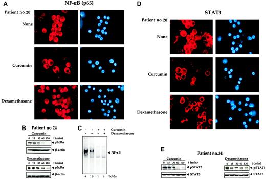 Figure 6. Effects of curcumin and dexamethasone. (A) Effect of curcumin and dexamethasone on nuclear localization of NF-κB. Enriched CD138+ cells (1 × 105 cells/0.1 mL) from bone marrow aspirates of multiple myeloma patient no. 20 were cultured in the absence or presence of curcumin or dexamethasone (50 μM each) for 2 hours, fixed the cells on slides by cytospin centrifugation, and immunostained for NF-κB, as described in “Patients, materials, and methods.” Original magnification, × 200. (B) Effect of curcumin and dexamethasone on phosphorylation of IκBα. A total of 2 × 106 CD138+ multiple myeloma cells were treated with curcumin (50 μM) or dexamethasone (50 μM) for the indicated times, and prepared the cytoplasmic extracts, resolved 30 μg cytoplasmic extracts on 10% SDS-PAGE gel, electrotransferred on a nitrocellulose membrane, and probed for phosphorylated IκBα by Western blot analysis. β-actin was used as a loading control. (C) Enriched CD138+ cells (2 × 106 cells) from bone marrow aspirates of multiple myeloma patients were treated with curcumin (50 μM), dexamethasone (50 μM) alone, or in combination for 3 hours and then tested for NF-κB activity in the nuclei by electrophoretic mobility shift assay as described in “Patients, materials, and methods.” (D) Effect of curcumin and dexamethasone on nuclear localization of STAT3. Enriched CD138+ cells (1 × 105/0.1 mL) from bone marrow aspirates of multiple myeloma patient no. 20 were cultured in the absence or presence of curcumin or dexamethasone (50 μM each) for 2 hours, then fixed the cells on slides by cytospin centrifugation and immunostained for STAT3, as described in “Patients, materials, and methods.” Original magnification, × 200. (E) Effect of curcumin and dexamethasone on phosphorylation of STAT3. A total of 2 × 106 CD138+ multiple myeloma cells were treated with curcumin (50 μM) or dexamethasone (50 μM) for the indicated times, prepared the whole cell extracts, resolved the 30 μg whole cell extracts on 10% SDS-PAGE gel, electrotransferred on a nitrocellulose membrane, and probed for phosphorylated STAT3 by Western blot analysis. STAT3 was used as a loading control.