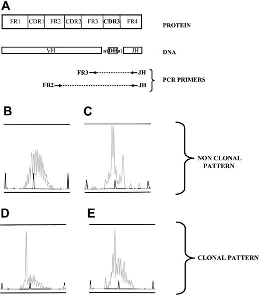 Figure 1. Clonality pattern of immunoglobulin gene rearrangements, analyzed by PCR. (A) DNA was extracted from samples, and 2 PCRs were performed using 2 sets of primers (FR3/JH and FR2/JH) to amplify all the size-variable CDR3 rearranged regions (FR2, GC(C/T) (C/T)CC GG(A/G) AA(A/G) (A/G)GT CTG GAG TGG; FR3, ACA CGG C(C/T)(G/C) TGT ATT ACT GT; JH, ACCTGAGGAGACGGTGACC). (B-E) PCR products were loaded on an ABI prism fragment size gel analysis. Four patterns were observed; when a polyclonal B-cell population was present in the sample, random sizes of all CDR3 regions resulted in a gaussian distribution of peak sizes (B). Several peaks could dominate in a sample without individualization of one peak, reflecting an oligoclonal pattern (C). One peak could be clearly individualized, either with a strongly dominant pattern, ie, with a low polyclonal background (D) or as a weak dominant peak, that is, with an intense polyclonal background (E). Patterns such as those in panels B and C were considered nonclonal. When a pattern such as that in panel D or E was observed either from FR3/JH or FR2/JH PCR, the sample was considered clonal.