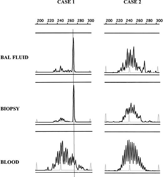 Figure 2. Comparison of B-cell clonality in BAL fluid, pulmonary biopsy, and blood. DNA from BAL fluid, biopsy, and blood samples was amplified, and PCR products were loaded on an ABI prism fragment size gel analysis. By using size marker (gray peak) and Genscan software, CDR3 size of the dominant peak could be determined and compared between different samples in a single patient. In case 1, the same dominant peak can be seen in PCR products obtained from BAL fluid and pulmonary biopsy but not from a blood sample, showing the presence of the same clonal B-cell population in both biopsy lymphocyte infiltrate and BAL fluid. In case 2, no dominant peak was detected in any analyzed tissue.