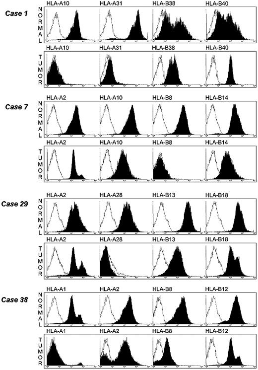 Figure 4. Detection of selective HLA class I allelic losses on leukemic cells by flow cytometry analysis. Leukemic and autologous normal cells were stained with HLA class I allele–specific mAb (black) and analyzed by flow cytometry. Cells stained with irrelevant isotype-matched mAb were used as controls (white).