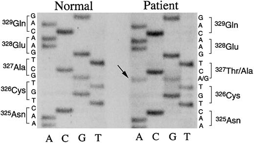 Figure 4. Nucleotide sequences of the γ chain gene exon VIII. Single-stranded DNA, amplified by the asymmetrical PCR method,7,8 from the γ chain gene exon VIII derived from a healthy subject or the patient, was subjected to direct nucleotide sequencing using 35S-dATP and Sequenase. The pertinent portion of the autoradiography of urea-polyacrylamide gel electrophoresis is shown. Both G and A (arrow) were detected at position 5884 of the patient γ chain gene, coding for Ala (GCT) and Thr (ACT), whereas only G for Ala (GCT) was identified at the same position of the normal γ chain gene.
