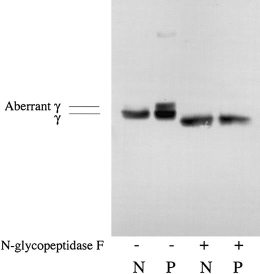 Figure 5. Analyses of deglycosylated fibrinogen. Normal fibrinogen (N) and patient fibrinogen (P) were treated with (+) or without (-) N-glycopeptidase F and analyzed by SDS-PAGE and Western blotting using γ chain–specific monoclonal antibody JIF 25. The γ chain (γ) and the aberrant γ chain (aberrant γ) were indicated.