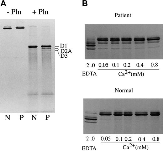Figure 7. Digestion of fibrinogen in the presence of calcium with plasmin. Fibrinogen (N: normal fibrinogen, P: patient fibrinogen) was treated with plasmin in Tris-buffered saline containing 2 mM calcium (A) or increasing concentrations of calcium or 2 mM EDTA (B) at 37°C for 1 hour. Untreated fibrinogen and plasmin digests of fibrinogen were analyzed by SDS-PAGE under nonreducing conditions. Fragments D1, D2A, and D3 are indicated. The relative amounts of Tokyo V fibrinogen fragments D2A and D3 were quantified by densitometry, and were approximately 17.5% of the sum of fragments D1, D2A, and D3 (mean of 2 experiments).
