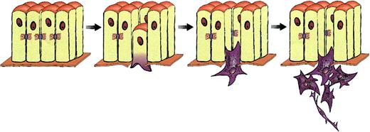 Figure 3. Tumorigenesis and metastasis entail EMT. A stationary epithelial cell is shown to lose contact with neighboring cells and to undergo EMT to become a motile, and eventually metastatic, cell.