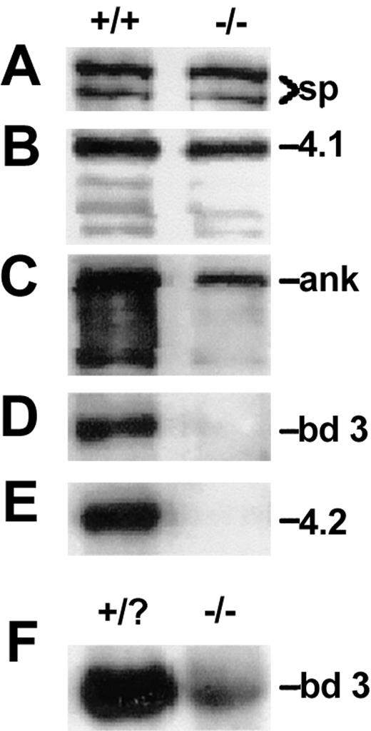 Figure 2. Membrane skeleton proteins in wan homozygotes. (A-E) Western blots showing levels of spectrin (sp, A), protein 4.1 (4.1, B), ankyrin (ank, C), band 3 (bd 3, D), and protein 4.2 (4.2, E) in normal (+/+) and wan/wan (-/-) RBC ghosts. Note the absence of band 3 and protein 4.2 and the decrement of ankyrin in mutant RBCs. In panel D, a peptide antibody raised to amino acids 214 to 228 of the cytoplasmic domain of band 3 was used. The same result was obtained using a pan-cytoplasmic domain band-3 antibody as well as a peptide antibody recognizing the C-terminal 12 amino acids of the membrane spanning domain, confirming that wan homozygotes are band-3 null. (F) Northern blot showing the severe decrement in band-3 mRNA in wan homozygotes. Each lane contains 2 μg total RNA purified from 2 pooled mutant (-/-) and 4 phenotypically normal (+/?) newborn peripheral blood samples whose genotypes were subsequently confirmed by PCR (see “Materials and methods”).