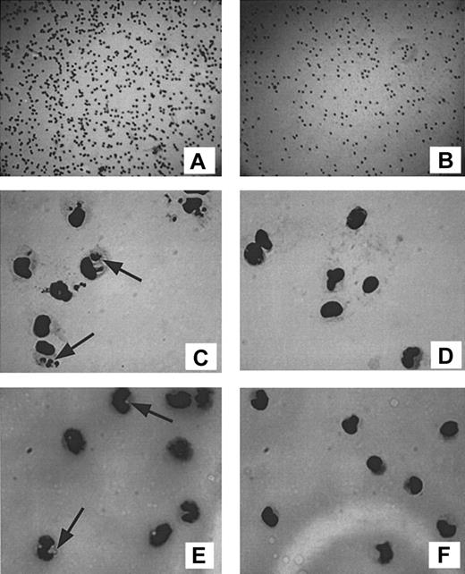 Figure 7. Effects of uninfected erythrocytes on the phagocytosis of iRBCs and latex beads by adherent cells. PBMCs (106/mL) were allowed to adhere to chamber-well slides. Nonadherent cells were washed off, and the remaining adherent fraction was subsequently incubated in duplicates for 2 or 18 hours (3 donors each) with 5 × 105/mL iRBCs, PfSL (not shown), GM, or equivalent numbers of 2.8-μm latex beads, in the presence or absence of 1:10 diluted uninfected erythrocytes, Giemsa stained, and visualized by light microscopy. Representative images are shown of adherent monocytes (A) and their reduced numbers following addition of uninfected erythrocytes (B) (magnification, × 100 for both panels), phagocytosis of iRBCs by adherent monocytes in the absence (C) or presence (D) of uninfected erythrocytes, and phagocytosis of latex beads by adherent monocytes in the absence (E) or presence (F) of uninfected erythrocytes (magnification, × 1300; oil immersion for panels C-F). Arrows indicate iRBCs or latex beads.