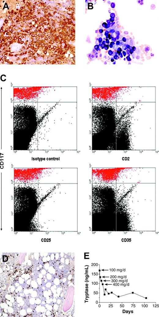 Figure 2. Histopathologic features of bone marrow biopsy and aspirate and response to therapy. (A) Bone marrow biopsy section immunohistochemically stained for tryptase (brown color); (B) aspirate stained with Wright-Giemsa; (C) flow cytometric analysis of the bone marrow aspirate. Mast cells are depicted in red in the upper part of the dot plots. (D) Bone marrow biopsy obtained 2 months after initiation of therapy, stained for tryptase. Compare with panel A. (E) Serum tryptase level during the course of treatment. Imatinib mesylate was started at a dosage of 100 mg once daily and increased to 200, 300, and 400 mg daily on days 5, 8, and 12, respectively. Original magnification, × 40 (A-B); and × 10 (D).