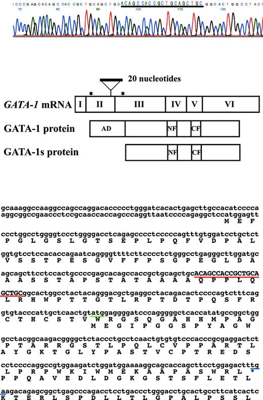 Figure 1. GATA1 mutation in an adult patient with AMKL not accompanying DS. Direct sequence analysis of cDNA and genomic DNA from AMKL blast cells of the adult patient who did not have accompanying DS showed that 20 nucleotides of the duplicated sequence were inserted in exon 2 of the GATA1 gene. The mutation resulted in the introduction of a premature stop codon in the gene sequence encoding the N-terminal activation domain. The predicted protein from a downstream initiation site, GATA-1s, lacks the transactivation domain.
