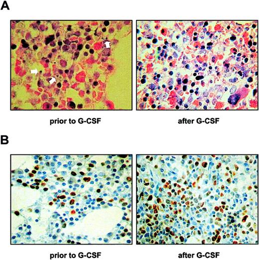 Figure 1. Enhanced bone marrow apoptosis in Kostmann syndrome. (A) Bone marrow biopsies from patient 2 were obtained prior to or after the initiation of G-CSF treatment, and sections were stained with hematoxylin-eosin and Giemsa for the morphologic evaluation of indices of apoptosis. Arrows indicate typical examples of apoptotic bodies in the pretreatment specimen. Apoptosis was significantly diminished in sections obtained during treatment with G-CSF. (B) Cell proliferation, as evidenced by immunohistochemical detection of the nuclear antigen Ki-67, is shown in bone marrow sections from patient 2 obtained prior to or after the initiation of G-CSF treatment. Similar data were obtained in all Kostmann patients included in the present study. Original magnification × 400.