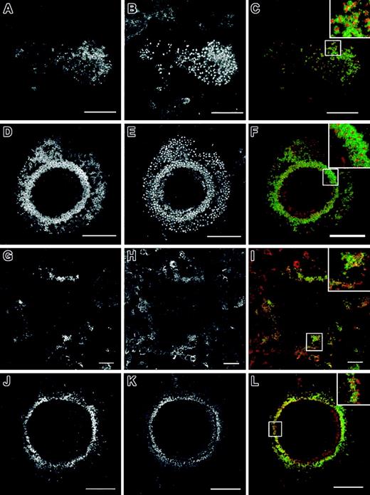 Figure 2. Cytoskeletal organization of normal and WASp-/- osteoclasts on glass coverslips. Bone marrow osteoclasts were derived on glass coverslips. At day 7 after plating, cell cultures were fixed with 3% paraformaldehyde, permeabilized with 0.05% Triton X-100, and stained with a mouse anti-human antibody against vinculin (A, D, G, J) and Alexa 568-conjugated phalloidin, followed by an incubation with an Alexa 488 goat anti-mouse antibody (B, E, H, K). Merged images are shown in panels C, F, I, and L. Normal osteoclasts assemble podosomes in clusters behind leading edges (A-C) or inserted in actin rings (D-F) with the characteristic organization of these adhesion structures: core of actin filaments surrounded by a rim of vinculin (inserts in C, F). WASp-null osteoclasts were defective in the formation of podosomes (G-I), instead assembling actin plaques colocalizing with vinculin (insert in I) or actin rings with few podosome-like structures inserted (J-L), which were depleted of vinculin (insert in L). The micrographs are representative of the cytoskeletal organization of osteoclasts detected in 3 independent experiments. Bar, 20 μm.