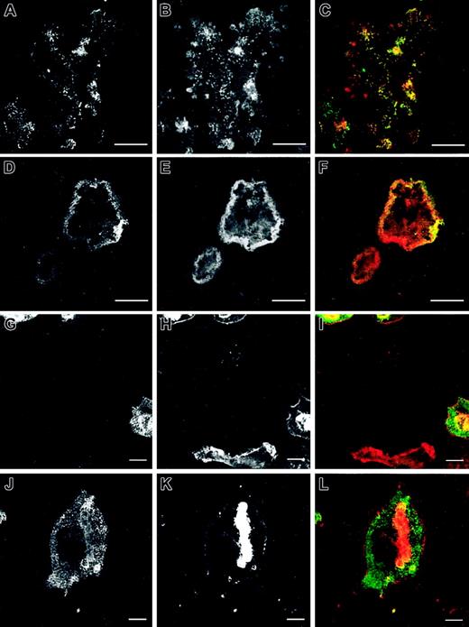 Figure 3. Cytoskeletal organization of normal and WASp-/- osteoclasts on bone slices. Bone marrow osteoclasts were derived on bone slices. At day 10 after plating, cell cultures were fixed with 3% paraformaldehyde and permeabilized with 0.05% Triton X-100 and vinculin (A, D, G, J), and actin filaments (B, E, H, K) were detected by immunofluorescence as described in “Materials and methods.” Merged images are shown in panels C, F, I, and L. In normal cells, podosomes were assembled either in noncircular clusters across the cell body (A-C) or, more commonly, in actin rings, where they were more diffuse than on glass coverslips (D-F). Vinculin colocalized with podosomes (A-C) and actin rings (D-F). WASp-null cells were devoid of podosomes (G-I) or assembled large plaques of actin (J-L). Vinculin staining was poor in WASp-/- osteoclasts, where actin filaments were almost undetectable (G-I) and distributed throughout the cytoplasm of cells containing actin plaques (J-L). The images are representative of the cytoskeletal organization of osteoclasts detected in 3 independent experiments. Bar, 20 μm.