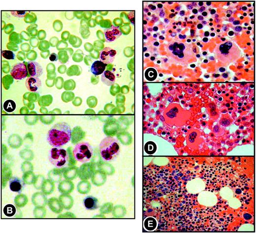 Figure 1. Composite of neutrophils and megakaryocytes. Shown are normal (A), hypogranular neutrophils (B), normal (C) and abnormal (D,E) megakaryocytes. Original magnification × 100.