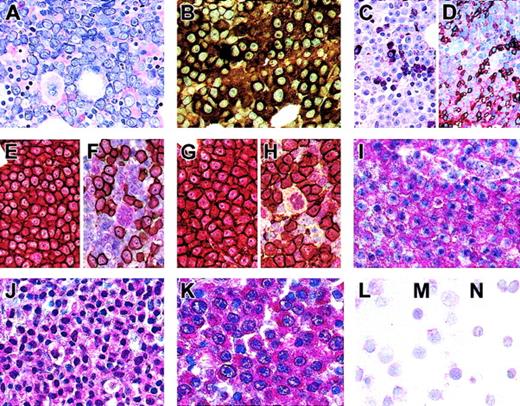Figure 1. High Notch1, Notch2, and Jagged1 expression in primary MM cells. (A-H) Bone marrow biopsy specimen of one case of MM. (A) Giemsa staining demonstrating bone marrow infiltration by atypical plasma cells (MM cells) with large nuclei and prominent nucleoli. (B) Immunostained MM cells show monotypic expression of immunoglobulin light-chain κ. (C-D) Immunostains for myeloperoxidase (C) and glycophorin C (D) mark granulocytic and erythroid precursors showing that MM cells are surrounded by nonmalignant bone marrow cells. (E-F) Double labeling for CD138 (brown reaction product; streptavidin/biotin/peroxidase technique) and Notch1 (red reaction product; immunoalkaline phosphatase method) reveals that CD138+ MM cells strongly coexpress Notch1. (G-H) Double labeling for CD138 (brown reaction product) and the Notch ligand Jagged1 (red reaction product) demonstrates coexpression of CD138 and Jagged1 on MM cells. (F,H) Some CD138- nonmalignant bone marrow cells, mainly megakaryocytes, show weak immunoreactivity against Notch1 or Jagged1. (I-K) Extramedullar (liver) biopsy specimen of MM immunostained for Notch1 (I), Notch2 (J), and Jagged1 (K) and counterstained with hematoxylin. MM cells are intensely labeled by anti-Notch1, anti-Notch2, and anti-Jagged1 antibodies. (L-N). Isolated plasma cells (CD38+++/CD19+) from the nonneoplastic bone marrow of healthy donors (cytospins) show low to undetectable immunoreactivity against Notch1 (L), Notch2 (M), and Jagged1 (N). Original magnification × 200.