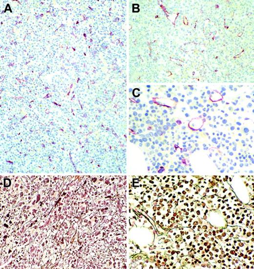 Figure 1. Bone marrow angiogenesis and myelofibrosis after first-line imatinib therapy of chronic-phase Ph+/BCR-ABL+ CML. (A-C) CD34 immunostaining. (D-E) Gomori silver impregnation. Original magnification, × 180 (A-B,D) and × 380 (C,E). (A) Pretreatment bone marrow biopsies reveal a significantly increased number of microvessels with enhanced tortuosity and branching. (B-C) Following imatinib treatment, a remarkable reduction of vascularity (B) accompanied by increased vascular roundness and decreased tortuosity of microvessels (C) is observable. These findings are generally associated with a reduction of the fiber content and occurrence of cytogenetic response. (D) Pretreatment biopsy. (E) Biopsy 8 months after imatinib treatment.