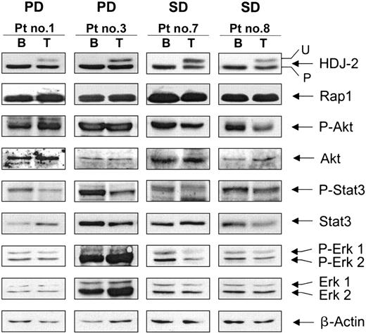 Figure 3. Effects of tipifarnib on HDJ-2 protein farnesylation, Rap1 geranylgeranylation, and the levels of P-Akt/Akt, P-STAT3/STAT3, and P-Erk1/2/Erk1/2 and β-actin in bone marrow cells from patients with advanced multiple myeloma. Bone marrow cells were processed for Western immunoblotting and probed with antibodies against HDJ-2, Rap1, β-actin, and phosphorylated as well as total Akt, STAT3, and Erk1/2 as described in “Materials and methods.” β-Actin was used as loading control. B and T designate baseline and week 3 of treatment with tipifarnib, respectively. PD and SD designate progressive disease and stable disease, respectively.