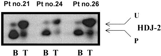 Figure 4. Tipifarnib treatment results in inhibition of HDJ-2 protein farnesylation in multiple myeloma cells. Multiple myeloma cells were prepared and processed for SDS-PAGE immunoblotting with anti-HDJ-2 antibody as described in “Materials and methods.” B and T designate baseline pretreatment levels and levels during the 3rd week of tipifarnib treatment, respectively. U and P designate unprocessed and processed HDJ-2, respectively.
