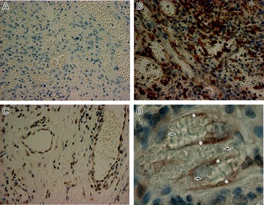 Figure 3. HO-1 expression in oral AIDS-KS tissue.Paraffin-embedded biopsy tissues from oral AIDS-KS lesions were sectioned and mounted on charged slides. The slides were deparaffinized and stained with polyclonal anti-HO-1 and counterstained with hematoxylin/eosin. (A) Rabbit Ig was used as a control for secondary specificity in sections taken from identical tissue blocks. The panel shows low background staining in an area of tumor involvement. Original magnification, × 40. (B) A similar area of tumor involvement from a section derived from the same tissue block shows a high degree of cellularity, numerous abnormal vascular spaces with extravasated erythrocytes, and a marked level of HO-1 expression (dark brown). Original magnification, × 40. (C) HO-1 expression in normal tissue at the tumor margin of the same tissue section shown in panel B. HO-1 was found within the endothelial lining of normal vascular spaces and sporadically in nonvascular regions. Original magnification, × 40. (D) Higher magnification of an area of tumor involvement from the same tissue section shown in panel B showing HO-1 staining in spindle-shaped cells (*) traversing abnormal, erythrocyte-congested vascular spaces (arrows). Original magnification, × 63.