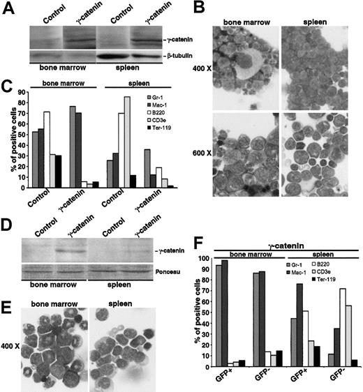 Figure 7. Leukemogenic potential of Sca1+/lin- transduced with γ-catenin and inoculated into sublethally irradiated mice. (A-C) Analysis of the mouse that developed disease symptoms after 9 months. (A) Western blot analysis of γ-catenin expression in the MNCs isolated from the BM and the spleen. Equal protein loading was confirmed after stripping of the membrane and staining with an anti-β-tubulin antibody. (B) Morphology of BM and spleen cells stained with May-Grünwald Giemsa. Two magnifications are given (× 400 and × 600). (C) Immunologic characterization of BM and spleen cells. Gr-1and Mac-1 characterize the myeloid lineage, B220 the B-lymphocytic lineage, CD3ϵ the T-lymphocytic lineage, and Ter119 the erythroid lineage. (D-F) Analysis of the mouse that developed disease symptoms after 12 months. (D) Western blot analysis of γ-catenin expression in the MNCs isolated from the BM and the spleen. Equal protein loading was confirmed by Ponceau staining of the membrane. (E) Morphology of BM and spleen cells stained with May-Grünwald Giemsa. Original magnification × 400. (F) Immunologic characterization of BM and spleen cells distinguishing between GFP-positive and -negative population. Gr-1 and Mac-1 characterize the myeloid lineage, B220 the B-lymphocytic lineage, CD3ϵ the T-lymphocytic lineage, and Ter119 the erythroid lineage.