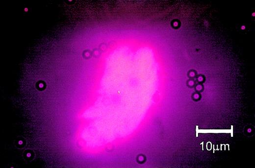 Figure 2. Circulating endothelial cell from a patient undergoing hematopoietic stem cell transplantation: immunomagnetic isolation and subsequent rhodamine-coupled UEA-1 stain. Note that several Dynabeads are attached to the cell and that the cytoplasm shows homogenous staining for UEA-1.