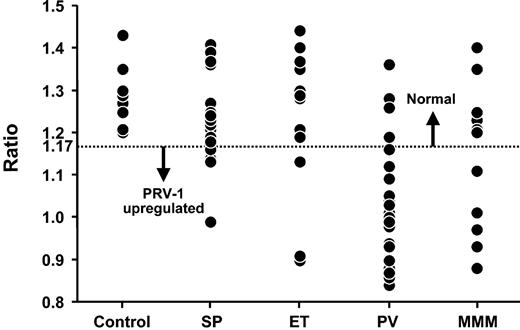 Figure 1. Neutrophil PRV-1 expression in healthy controls, secondary or spurious polycythemia (SP), essential thrombocythemia (ET), polycythemia vera (PV), and myelofibrosis with myeloid metaplasia (MMM). GAPDH indicates glyceraldehyde-3-phosphate dehydrogenase.