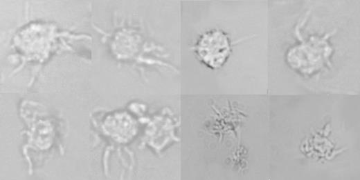 Figure 2. Direct visualization of cells with dendritic morphology from patients recovering from Allo-HSCT. Pictures were taken by direct optical microscopy of viable cells obtained from the low-density layer after centrifugation over hypertonic gradient following overnight culture of PBMCs isolated from 1 to 2 mL of peripheral blood. Original magnification, × 45.