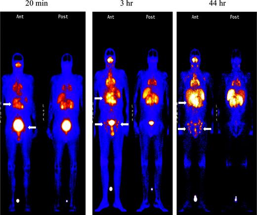 Figure 3. Tumor targeting of known sites of disease. Images obtained 20 minutes, 3 hours, and 44 hours after the administration of 111In (5 mCi)/90Y (15 mCi/m2)–DOTA-biotin. Gamma camera wholebody scans of patient no. 1 (anterior views) obtained at 20 minutes, 3 hours, and 44 hours after infusion of 111In/90Y-DOTA-biotin. Arrows are showing radionuclide localization to known sites of tumor involvement.