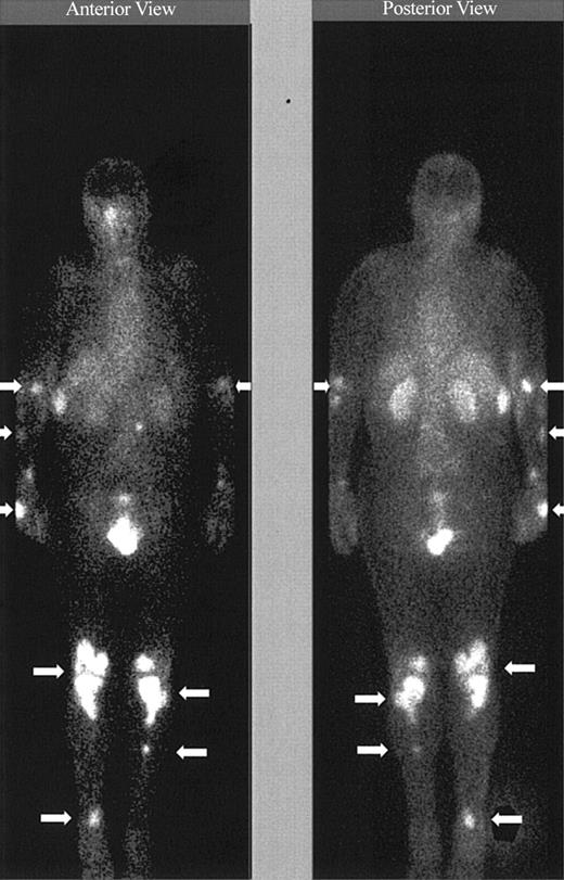 Figure 4. Tumor targeting of known sites of disease. Image obtained 46 hours after the administration of 111In (5 mCi)/90Y (15 mCi/m2)–DOTA-biotin. Gamma camera whole-body scans of patient no. 3 (anterior view on left and posterior view on right) obtained 46 hours after infusion of 111In/90Y-DOTA-biotin. Arrows are showing radionuclide localization to known sites of tumor involvement.