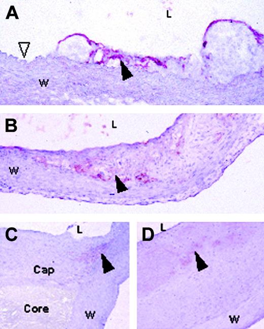 Figure 2. Mouse and human atherosclerotic lesions contain EIIIA-FN. (A) A cryosection of an ApoE–/– mouse aorta after high-fat diet for 8 weeks. EIIIA-FN is associated with lesional endothelial cells and occasional foam cells (black arrowhead). The unfilled arrowhead indicates absence of EIIIA-FN in non–lesion-associated endothelium. EIIIA-FN is not detectable in the smooth muscle wall (w). (B) Aortic lesion from an ApoE–/– mouse after high-fat diet for 16 weeks. EIIIA-FN is detected around lesional foam cells (black arrowhead). (C) Human carotid artery, indicating EIIIA-FN associated with scattered cells in the shoulder region of the lesion (black arrowhead). EIIIA-plus FN is not detectable in the fibrotic cap (cap), necrotic core (core), or the wall (w). (D) EIIIA-FN is associated with lesional macrophages and smooth muscle cells near the luminal surface (black arrowhead). L indicates vessel lumen. Original magnification, × 100.