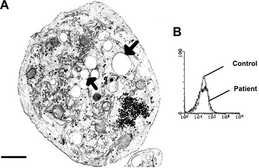 Figure 1. Characteristics of the patient's platelets that are suggestive of GPS. (A) A typical large round platelet devoid of α-granules and with a well-developed SCCS (arrows), as viewed by transmission EM. Scale bar equals 0.5 μm. (B) Histograms showing mepacrine labeling of the patient's and control platelets as a measure of dense granule content by flow cytometry.